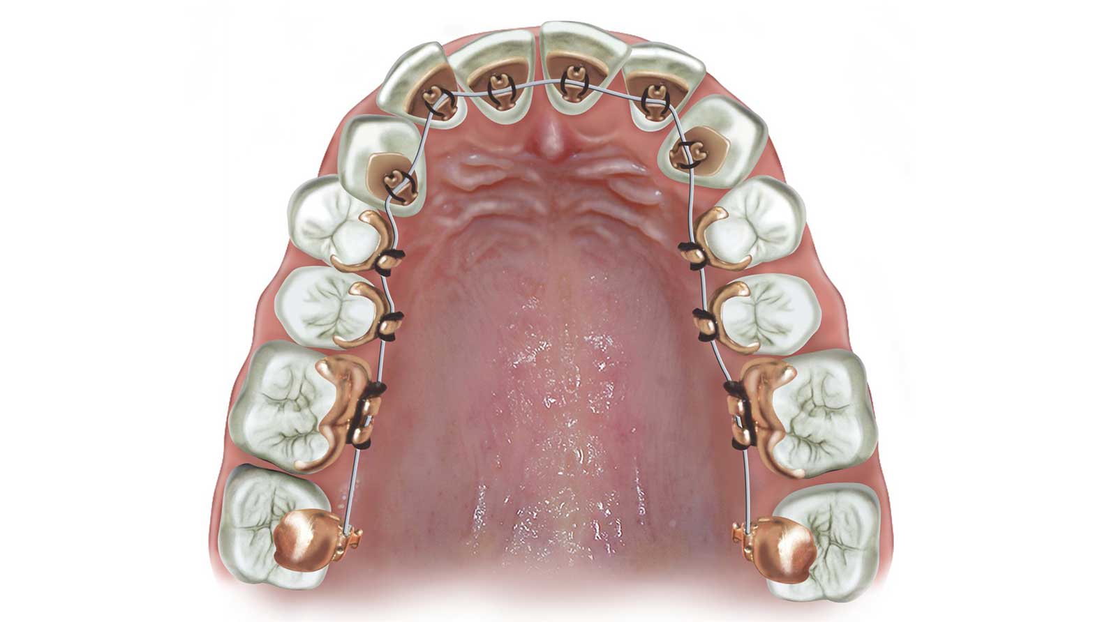 10 Bottoni Linguali Ortodontici Ovali Incollabili, Marca SmileOrtho, Per Archwire E Bande Molari