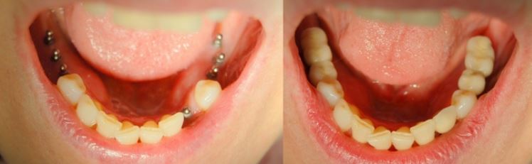 Quali Sono I Metodi Per Sostituire I Denti Mancanti Centro Medico Vesalio