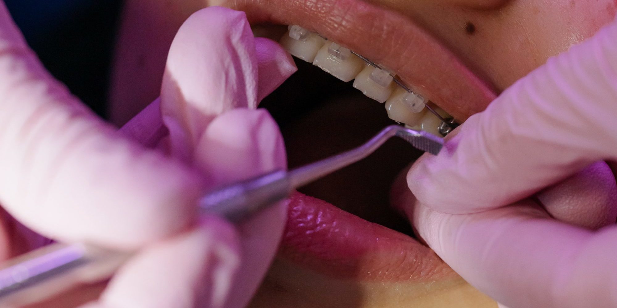 L'apparecchio ai denti giusto all'età corretta - Centro Medico Vesalio