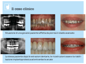 parodontite piorrea implantologia