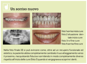 parodontite piorrea implantologia