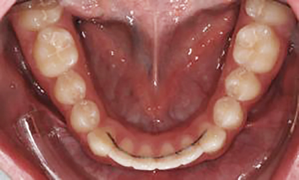 Ortodonzia contenzione fissa inferiore