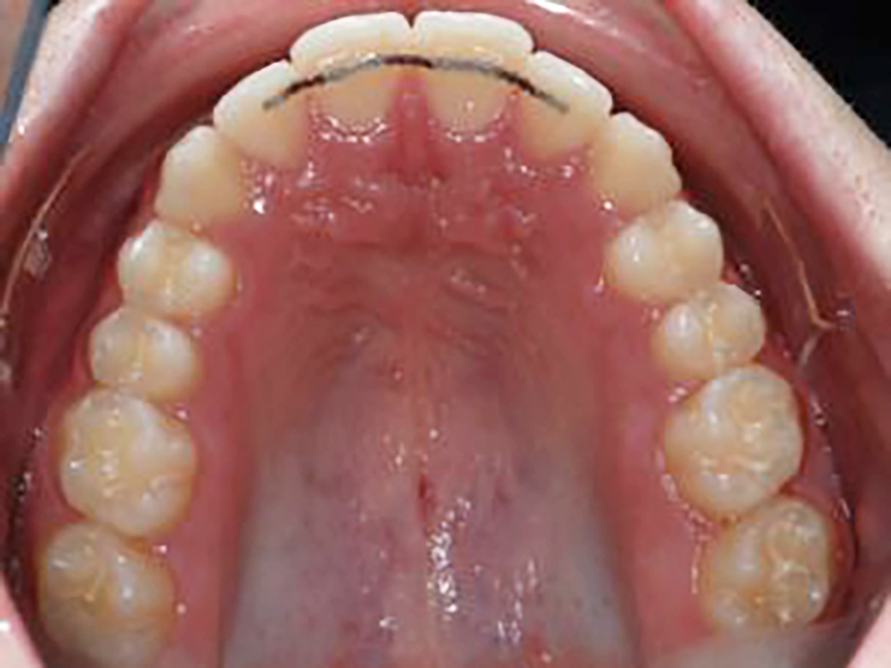 Ortodonzia contenzione fissa superiore