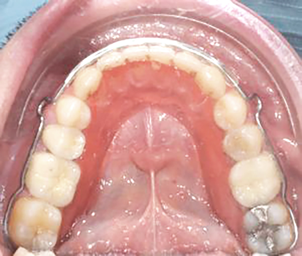 Ortodonzia contenzione rimovibile