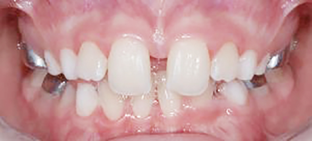 Espansore del palato ortodonzia