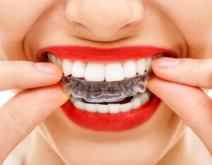 Allineatori trasparenti per i denti