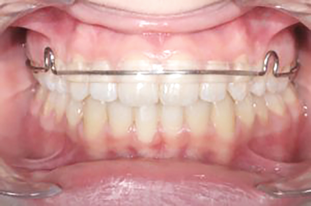 Ortodonzia contenzione rimovibile